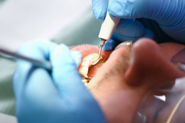 Best Emergency Dental Care for Broken or Chipped Teeth in Bay Hill, FL